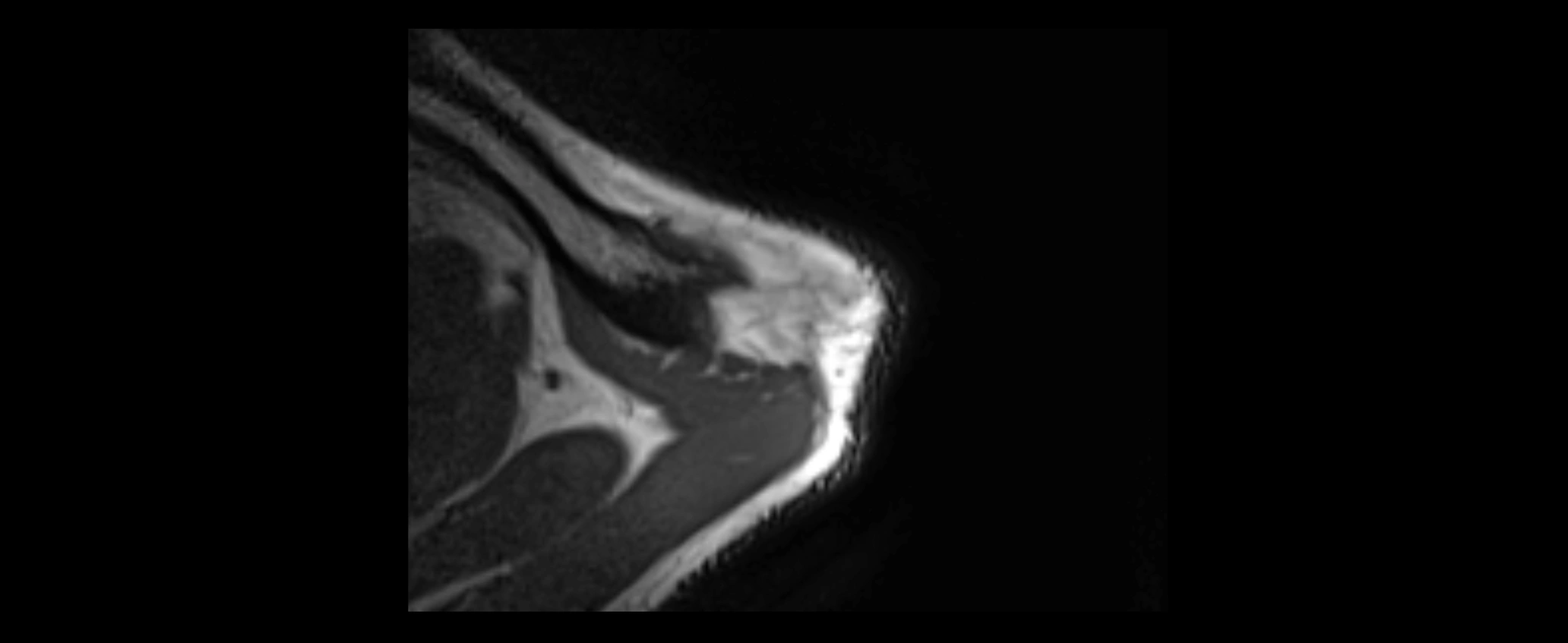 shoulder ligaments axial 3d 3t mri image-img-00005-00012.webp